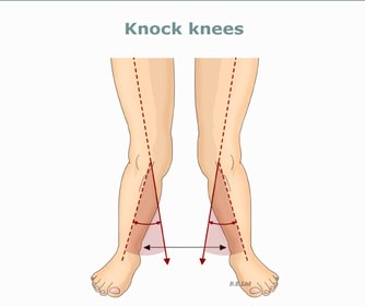 diagram shows what leg position is knock knees