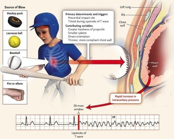 illustration of impact of commotio cordis in sports